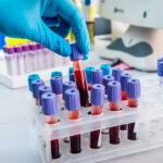 AI Predicts Recovery: Blood Test Breakthrough Gloved hand handling blood samples in a laboratory