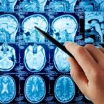 Brain Cell Massacre: Your Home Chemicals Exposed A hand pointing at MRI brain scans displayed on a screen